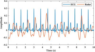 A novel target state detection method for accurate cardiopulmonary signal extraction based on FMCW radar signals